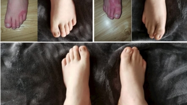 Feet-eczema-treatment