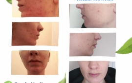 homeopathy-for-cystic-acne-dublin-15