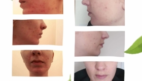 homeopathy-for-cystic-acne-dublin-15