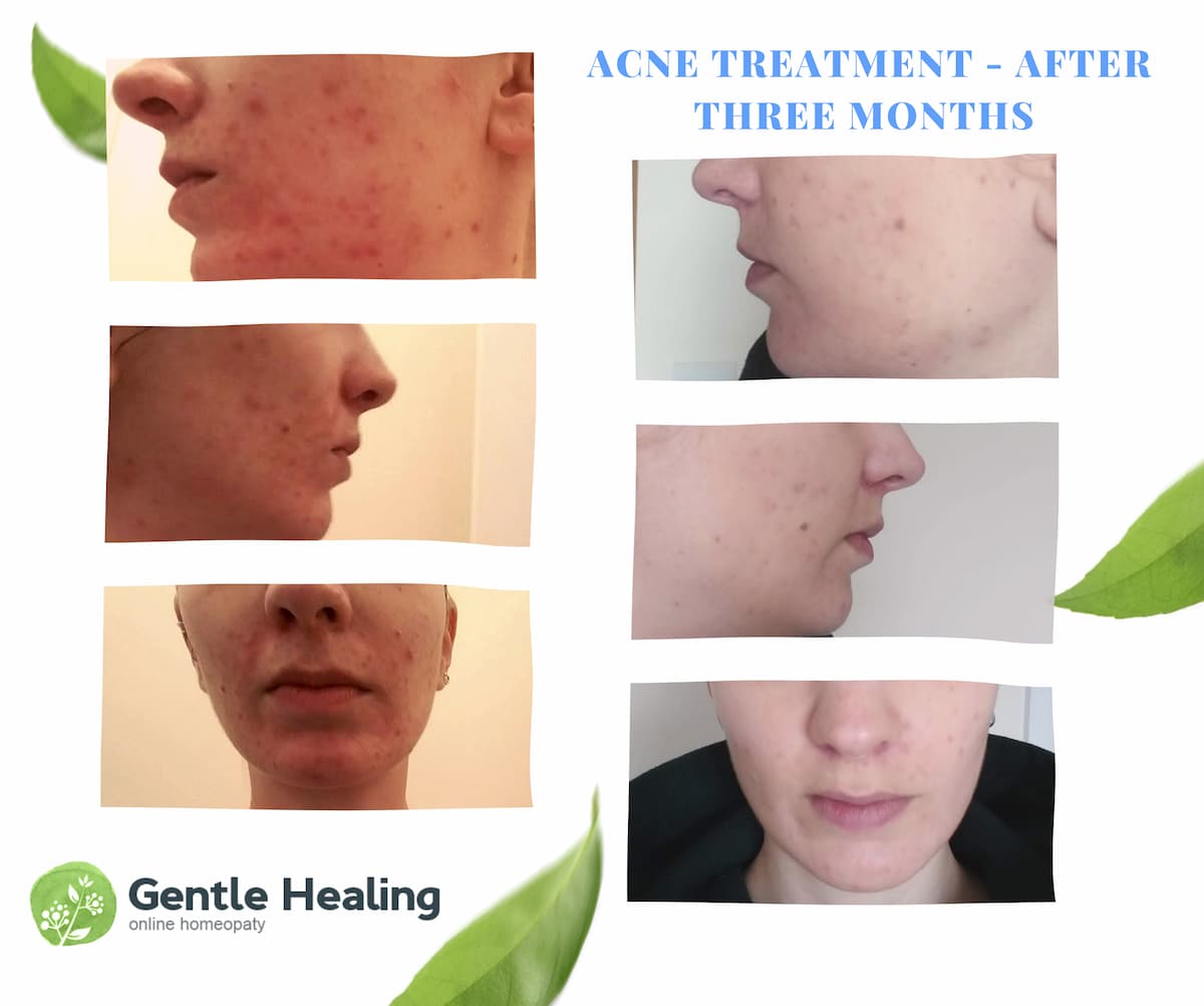 homeopathy-for-cystic-acne-dublin-15