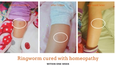 ringworm-treatment-homeopathy-dublin-15